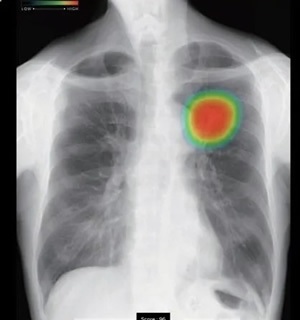 CXR-AIDで解析すると異常が確信度ごとにヒートマップで表示されます。